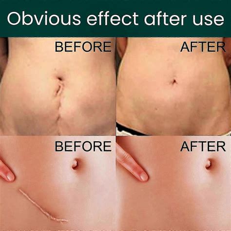 Silicone Scar Sheets for C-Section, Tummy Tuck, Keloid & Surgical Scars