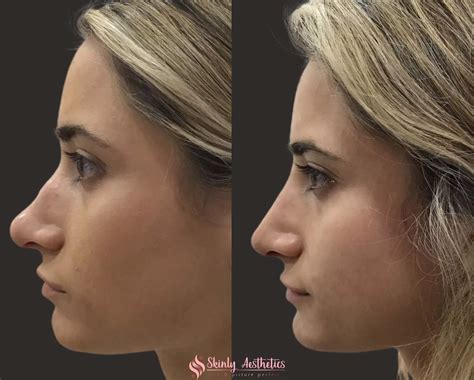 Non-Surgical Rhinoplasty - Before and After Results