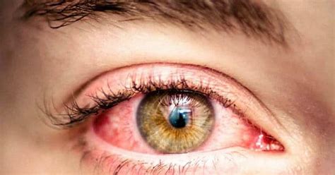 Pink Eye From Dog Farting On Pillow at Lee Porter blog