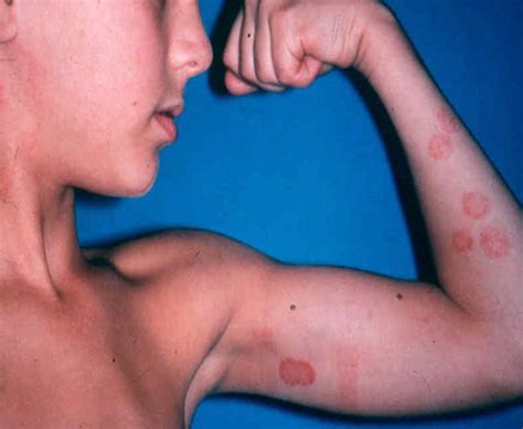 Why Skin Fungal Infections become more harmful ~ Lifecare Innovations