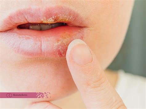 understanding cold sore stages remotederm