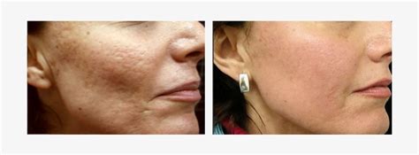 Acne Scars Treatments - Fraxel Laser Acne Scars - 733x245 PNG Download - PNGkit