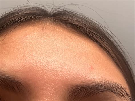 woke up with tiny itchy bumps on my face! : r/SkincareAddicts
