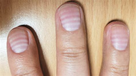 bizarre white lines  mans fingernails turned     sign