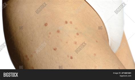 Burns Laser Hair Image & Photo (Free Trial) | Bigstock