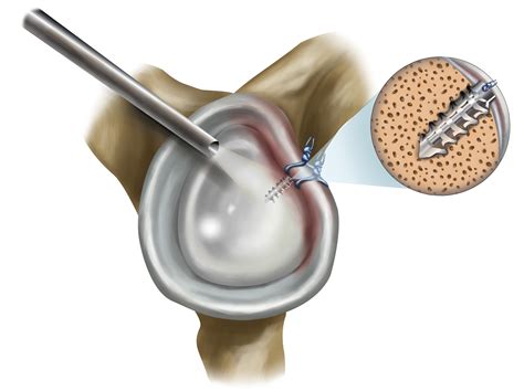 Bankart Tear on Behance