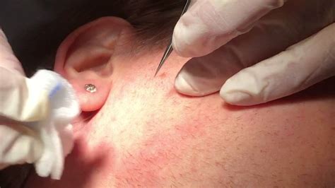 Permanent removal of facial hair by electrolysis - YouTube