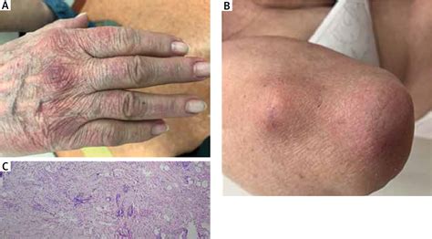 Challenging diagnosis of the spectrum of reactive granulomatous