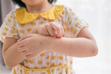 cara mengatasi anak alergi debu 12