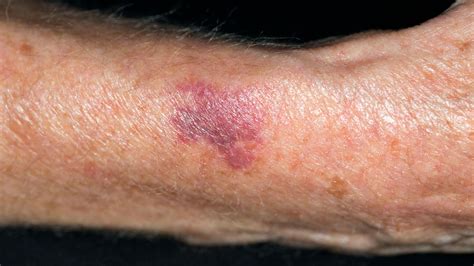 ecchymosis  arms