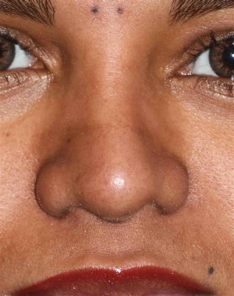 female bulbous nose rhinoplasty front after Dr Barry Eppley ...