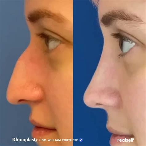 8 things to know before getting rhinoplasty – Artofit