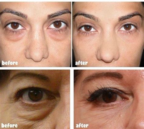 laser eye bag removal london  abby edwards blog