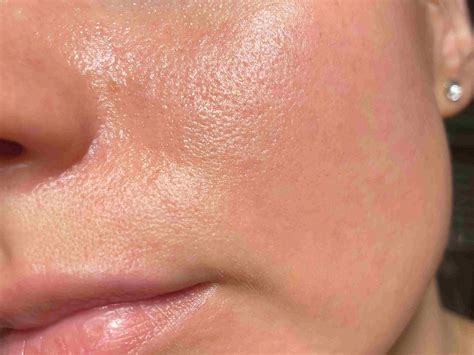 enlarged pores   treatments