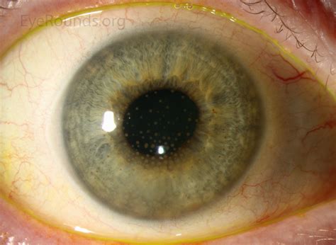 fine keratic precipitates
