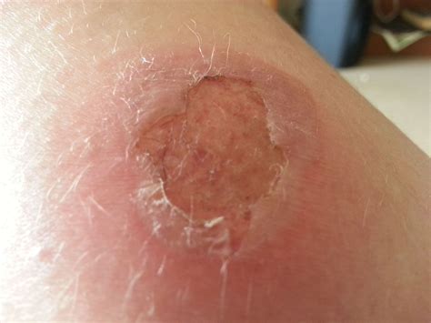 Second degree burn - sportnipod