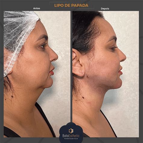 Como É Feita A Lipo De Papada - Tudo o que você precisa saber antes de fazer uma Lipo de Papada ...