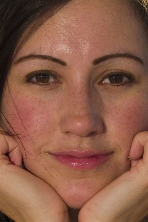 flushed cheeks  adults