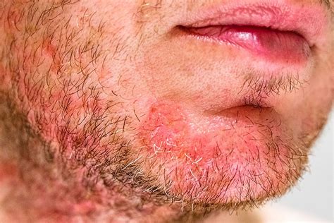 Demodex mites, the Microbiome and the Treatment of Rosacea | Border ...