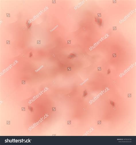 Inflammation Skin Erysipelas Psoriasis Seborrhea Dermatitis Stock