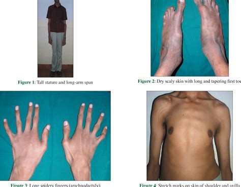 Unveiling the Complexities of Marfan Syndrome: A Comprehensive Overview ...