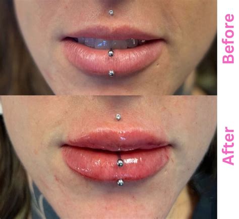 Lip Fillers Before and After Pictures | Get a Consultation Now!