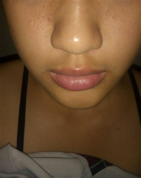 COMEDONAL ACNE – Acne – Acne.org Forum