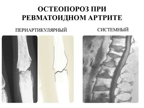 Ревматоидный артрит - презентация онлайн