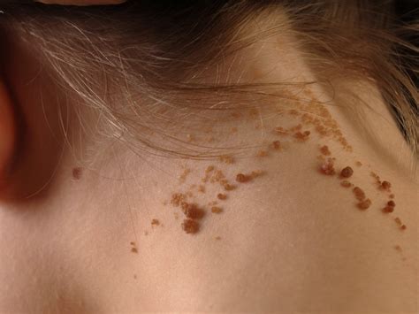 Epidermal Nevus