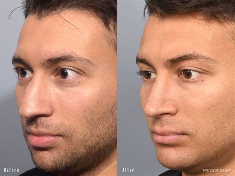 nose job    men male rhinoplasty