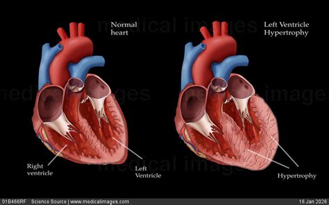STOCK IMAGE, , JB7872, 01B466RF , Science Source - Search Medical ...