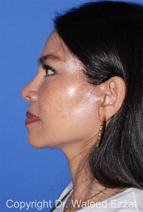 213 - The Boston Center For Facial Plastics