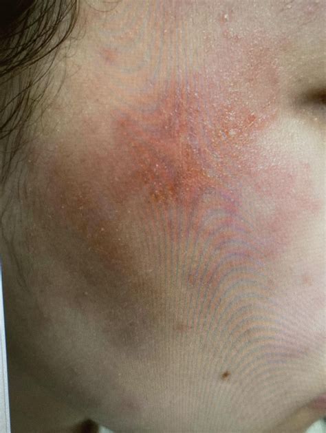 Dry, itchy, red, sometimes bumpy skin! What is my condition? : r ...