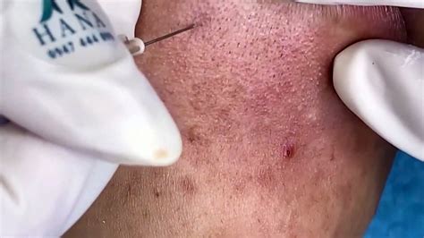 Say Goodbye to Blackheads with Unbelievable Blackhead Removal 2024 - moo951t