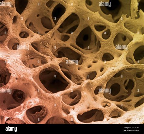 El tejido óseo. Color análisis micrografía de electrones (SEM) de hueso ...