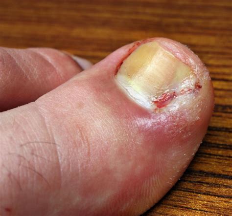 What Causes Discolored Toenails? (with pictures)