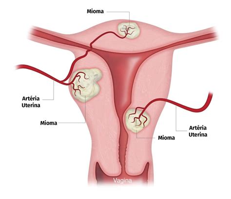 O'que É Mioma No Útero - Miomas Uterinos: causas, sintomas e tratamentos - Dra. Ana Luisa Lauletta