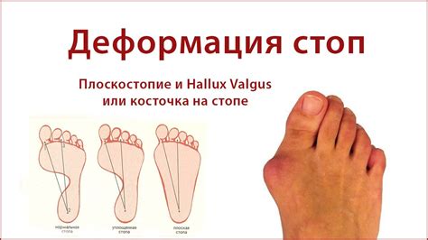 Деформация стоп - YouTube