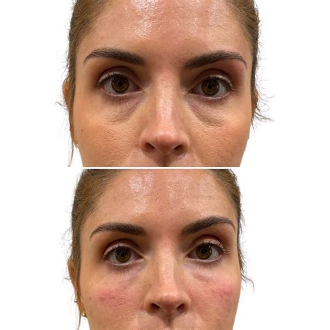 Dermal Filler Tear Trough | Best Hollow and Under Eyes Filler Clinic