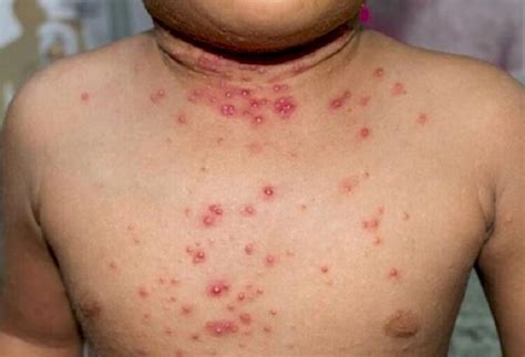 Mpox Em Crianças - Mpox: conheça os sinais e sintomas e como se pega a doença - Contexto