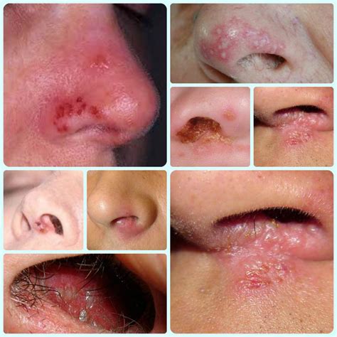 Collection 95+ Pictures Herpes On The Nose Photos Stunning 10/2023