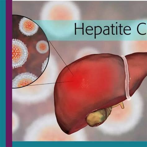 Hepatite C É Grave