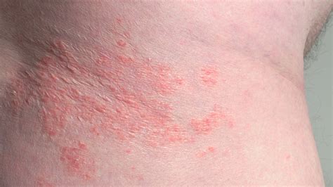 itchy rash  neck allergic reaction  kecia martin blog
