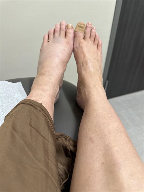 Has anyone ever had a lis franc midfoot dislocation? : r/ehlersdanlos