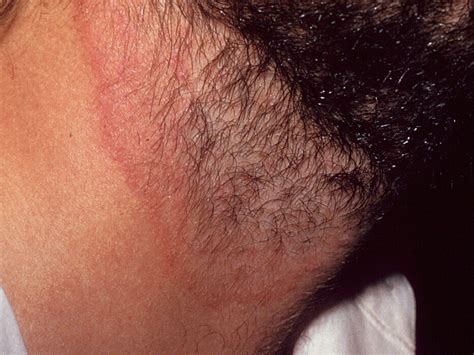 Cutaneous Mycoses | Mycology | University of Adelaide