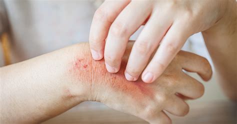 Lupus Butterfly Rash: Causes and Treatment Guide