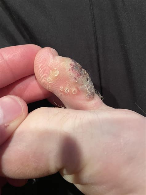 PLANTAR WART OR CORN? : r/Warts