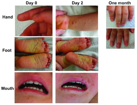 Photographs of a patient with the HFMD caused by CV-A6. Day 0 and 2 ...