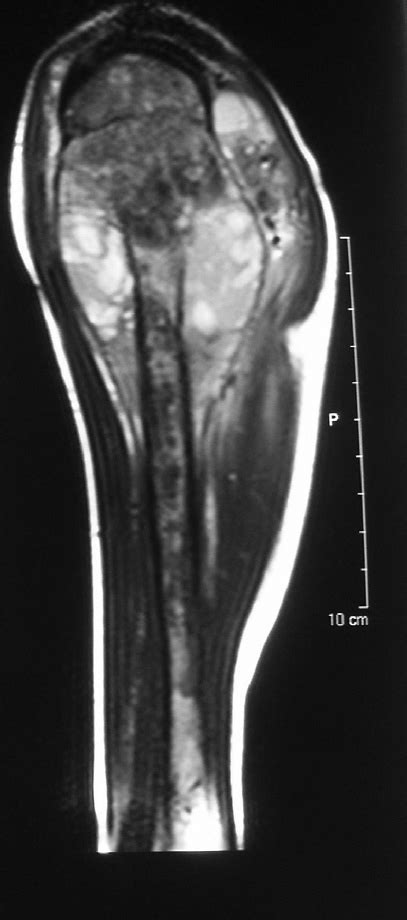 mri   humerus showing  extent   tumour
