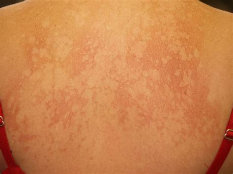 figure pityriasis versicolor dermnet  zealand statpearls ncbi